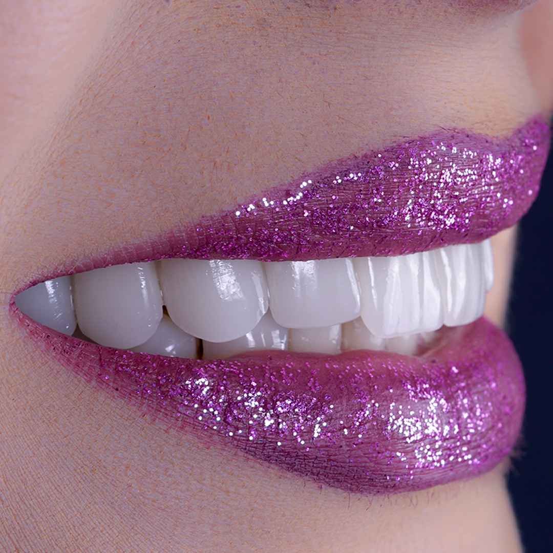 Sonrisa radiante mostrando su blanqueamiento dental